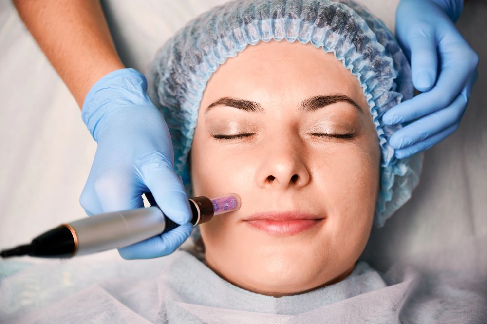 microneedling